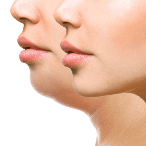 Fat dissolving injections melbourne