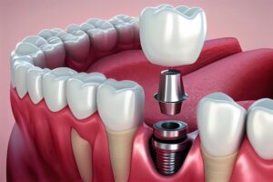 A Complete Guide to All on 4 Dental Implants: A Modern Solution for Full-Arch Tooth Replacement