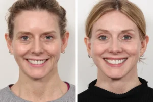 Thread Lift in Dubai for Under-Eye Lifting: Is It Effective?