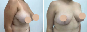 breast lift in dubai