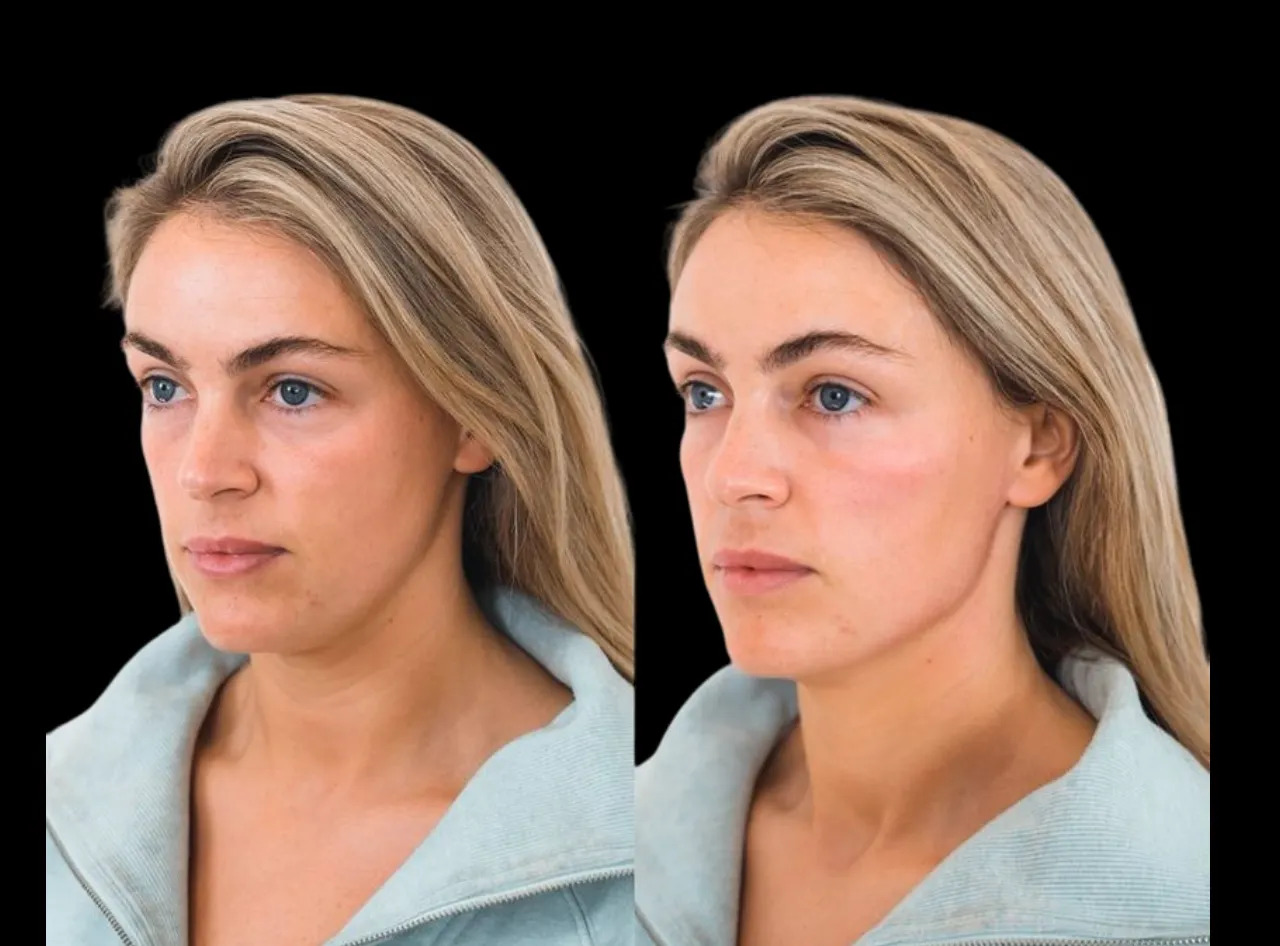 Fillers in Dubai