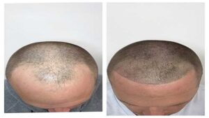 Hair Restoration Treatments