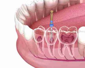 a dental implant