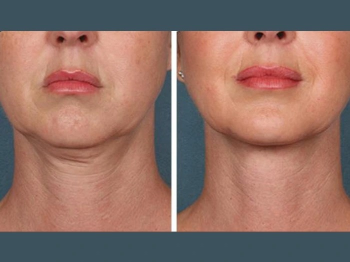 Prp Injections in Dubai
