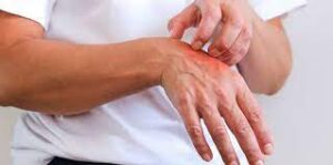 Scabies Infection Cure and Prevention Tips