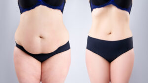Fat transfer in dubai