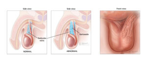 varicocele testicular