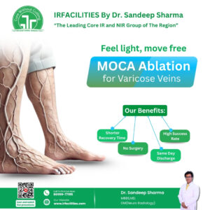 Varicose Veins Treatment in India