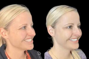Botox Treatment in Dubai for Men: What You Should Know