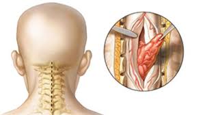 Spine Tumor Surgery in India: What to Expect Before, During, and After