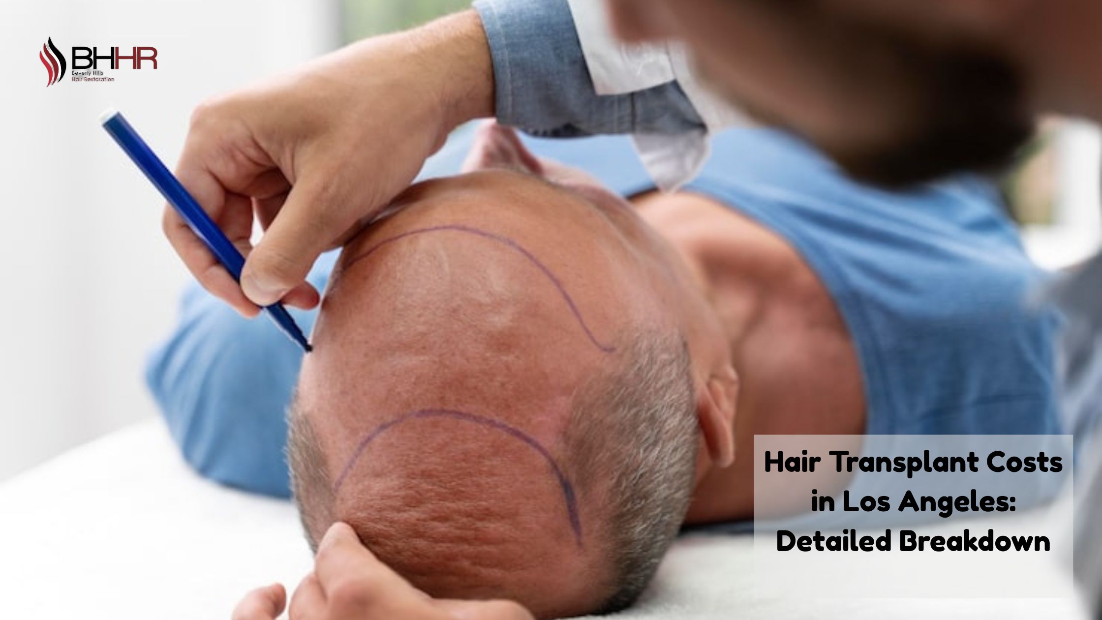 hair transplant los angeles cost