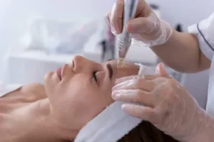 laser hair removal