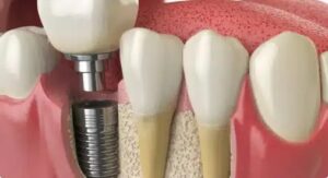 dental implant