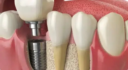 dental implant