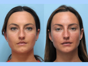 Experience Youthful Skin with Thread Lift Treatment in Dubai