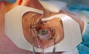 Top Reasons to Choose Arora Eye Centre as the Best Cornea Transplant Hospital in Karnal