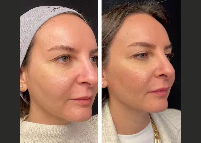 Mesotherapy in Dubai