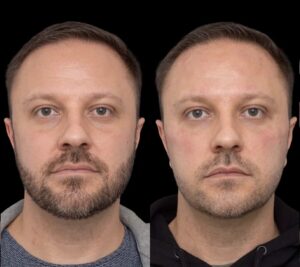 uynder eye fillers in dubai