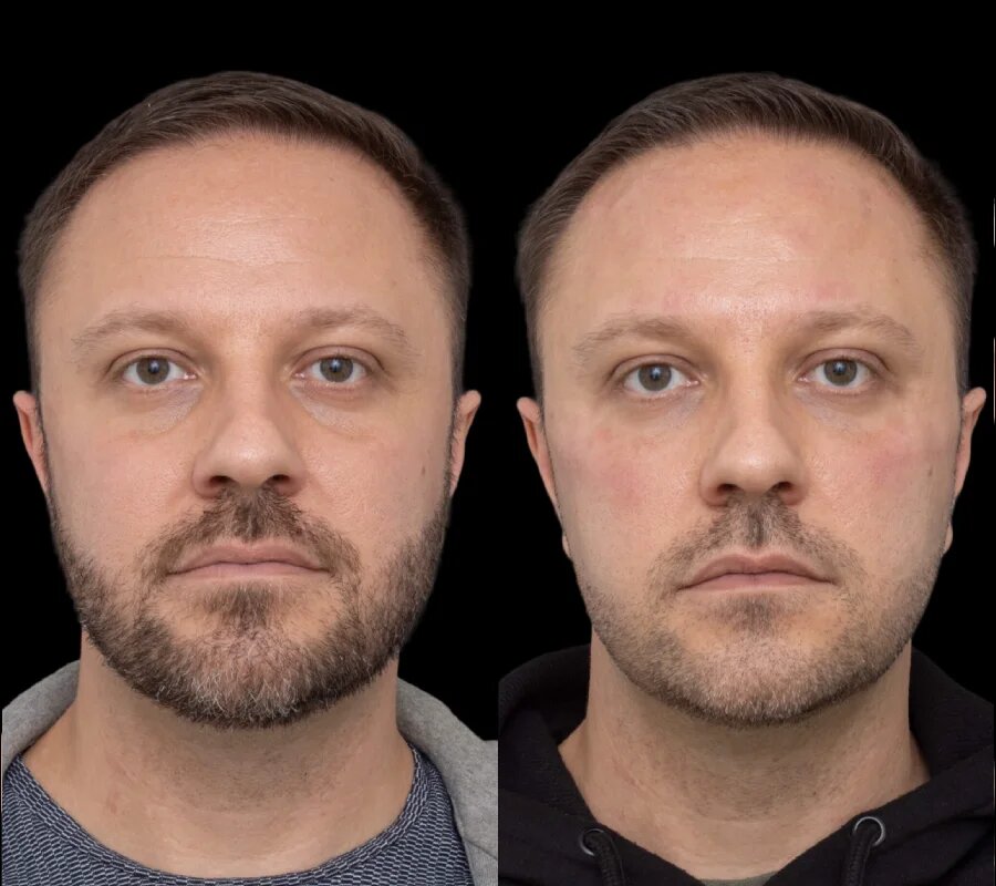 uynder eye fillers in dubai