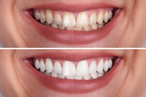 teeth whitening Chester