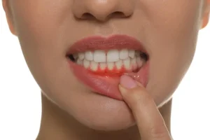 teeth bleeding