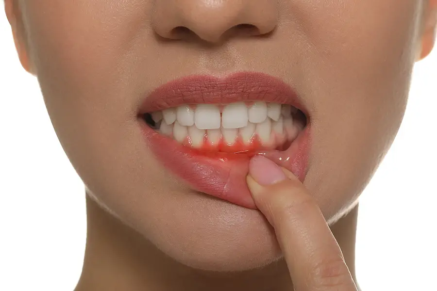 teeth bleeding