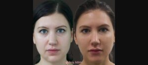 Patient jawline before and after Botox transformation