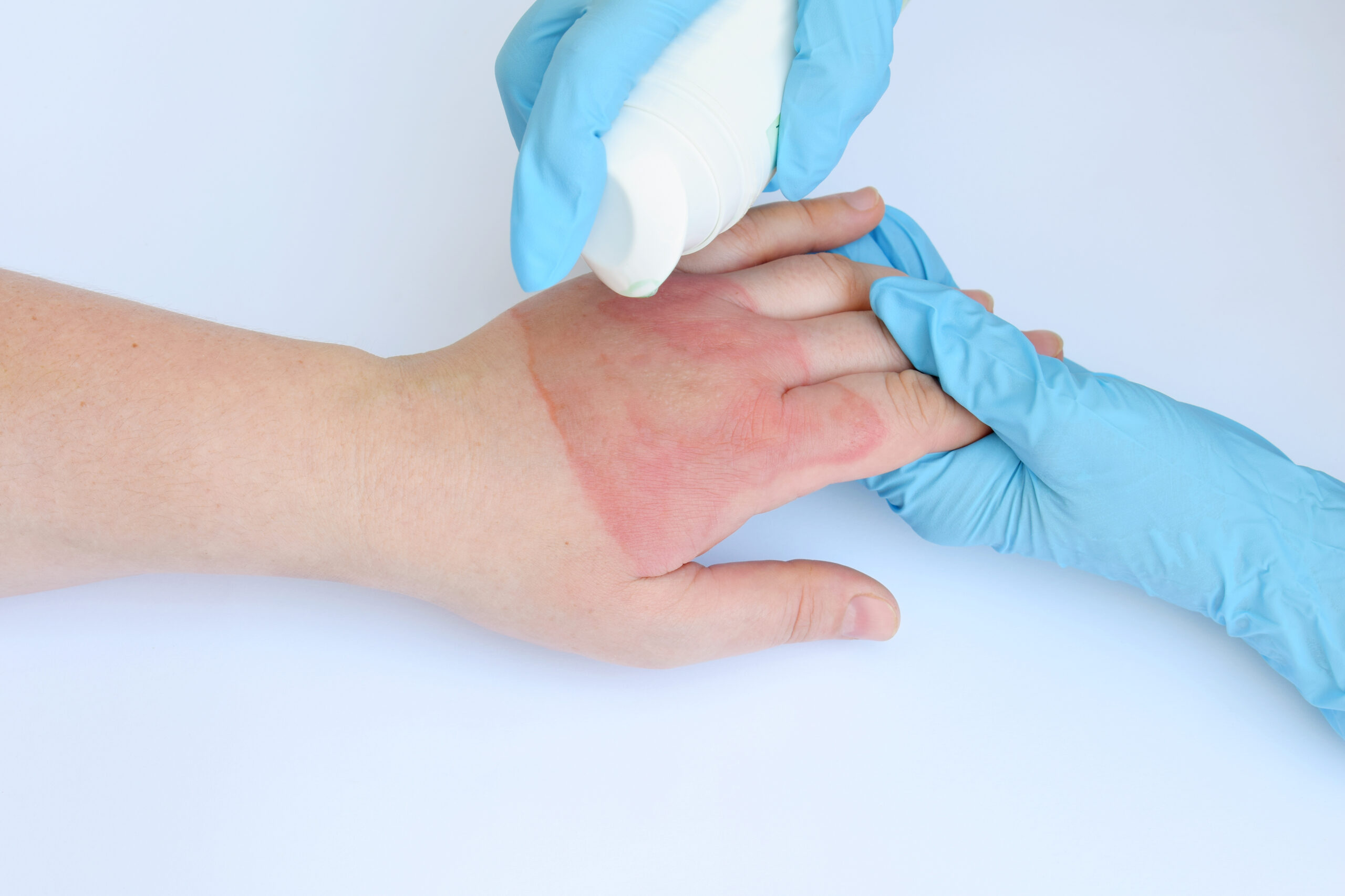 First Care burn treatments for minor and severe burns