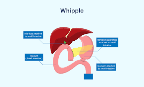 Understanding Whipple Surgery Cost in India for Pancreatic Cancer Patients