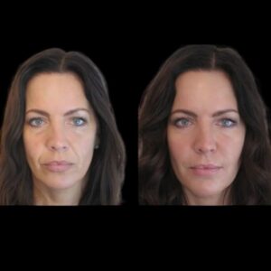 Fillers in dubai