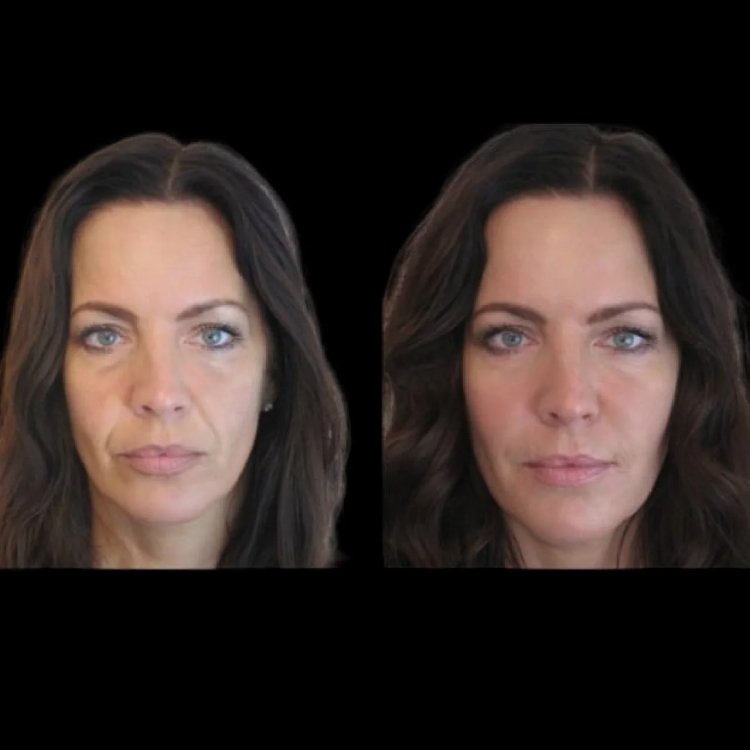 Fillers in dubai