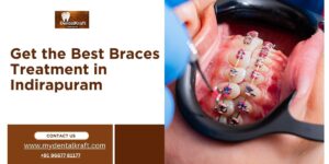 Braces Treatment