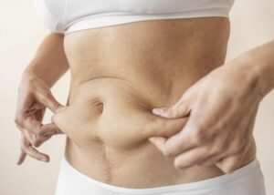 Liposuction in Dubai
