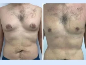 gynecomastia treatment